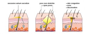 What are Open Pores?